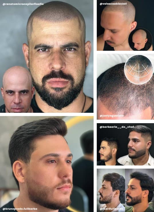 Kit Nuance Full Barba - Micropigmentação em Barba - PRÉ-VENDA - 5