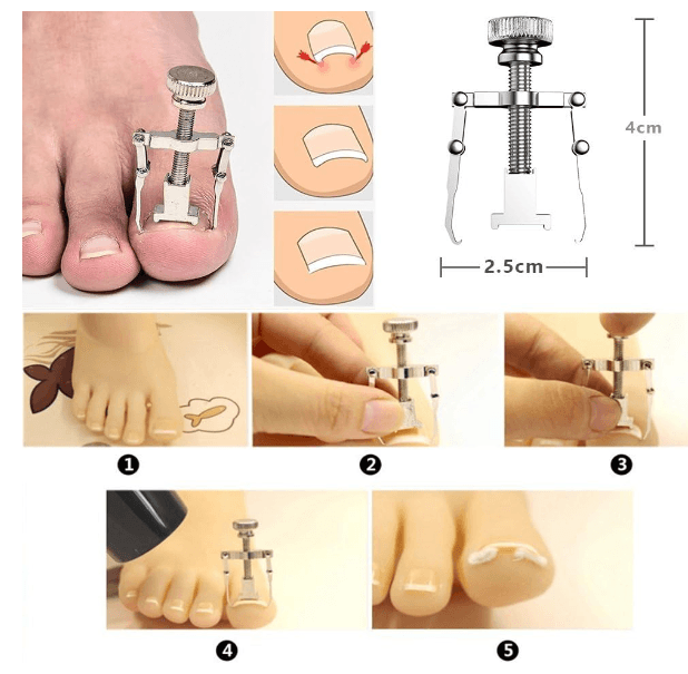 Professional Ingrown Nail Removal Kit - 2