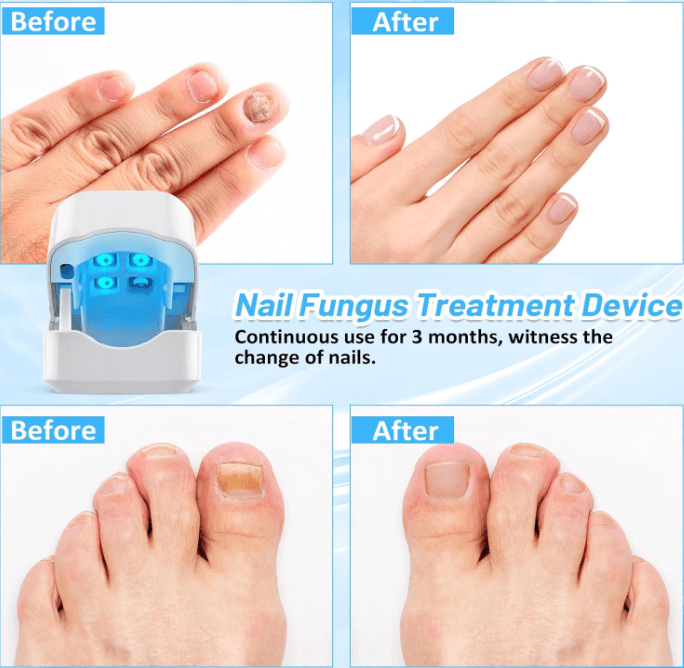 Laser Machine for Nail Fungus Cleaning - 5