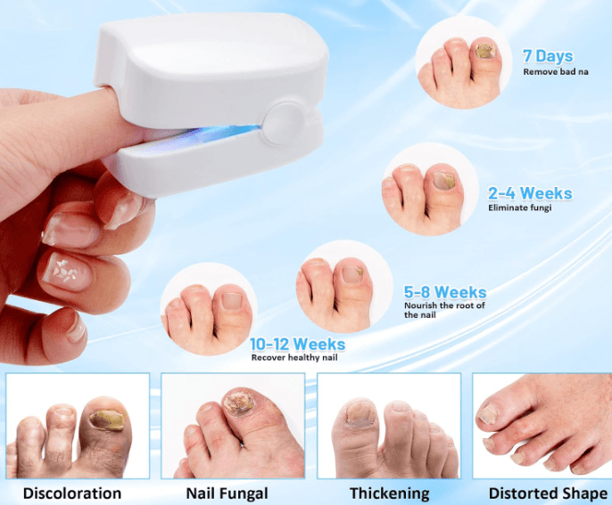 Laser Machine for Nail Fungus Cleaning - 4